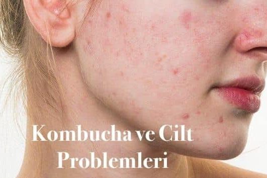 cilt sorunlarını kombucha çözümü